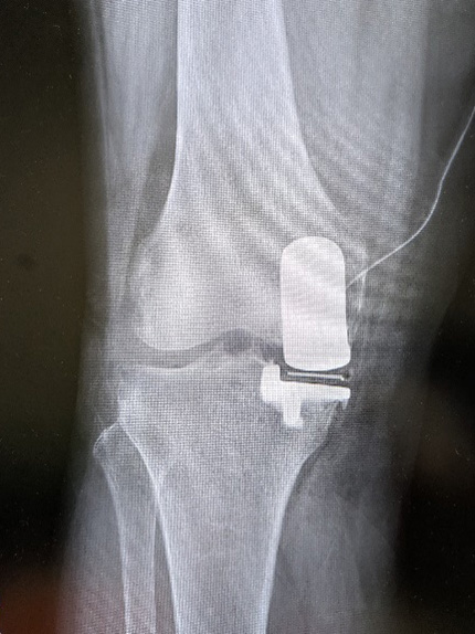 単顆部膝関節置換術 (UKA)